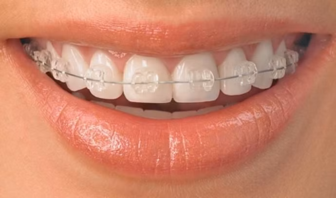 Những vấn đề thường gặp khi nắn chỉnh răng