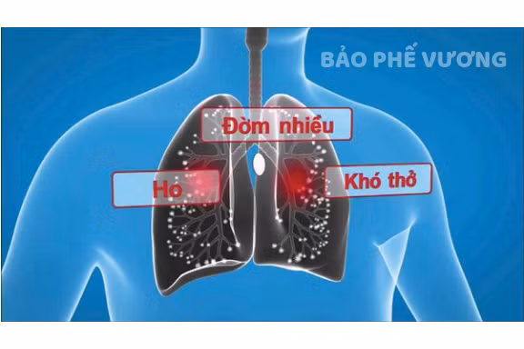 Ho khan, ho đờm là các triệu chứng thường gặp của viêm phế quản