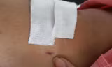 Vết khoan 'nhầm' của BS đối với bệnh nhân bị gãy đốt sống ngực