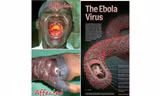 Cận cảnh người bị bệnh do vi rút Ebola. 