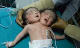 Bé sơ sinh hai đầu chào đời tại Bangladest