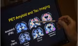 Ai nên xét nghiệm máu để phát hiện sớm bệnh mất trí nhớ Alzheimer?
