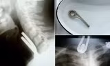 Ảnh chụp X-quang bệnh nhân khó thở vì chốt sắt nằm chắn trong cổ họng.