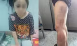 Nạn nhân bị hành hung nhiều bộ phận như mặt, chân, lưng
