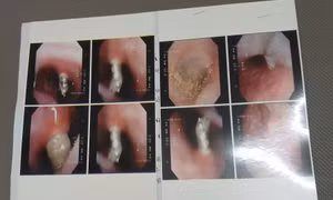 Bệnh nhân N.C.K bị 4 chiếc đinh vít nong hàm chọc thẳng lên mũi. Ảnh: NVCC. 