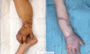 Tin mới nhất về kỳ tích ca phẫu thuật giúp thai phụ có tay để đón song sinh 