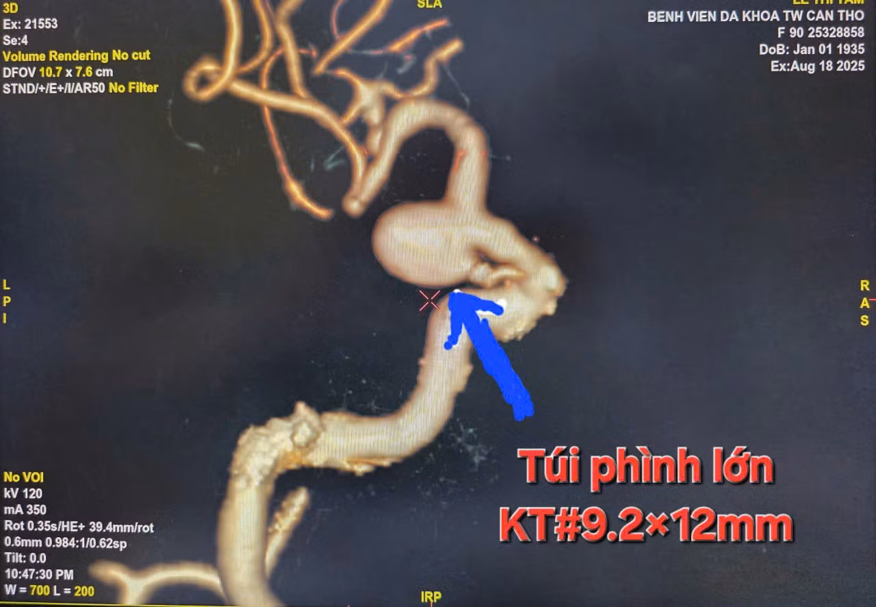 Hình ảnh túi phình kích thước lớn trong đầu cụ bà 90 tuổi.