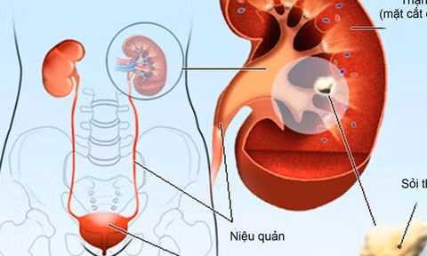 Cách phòng ngừa sỏi thận không dùng thuốc