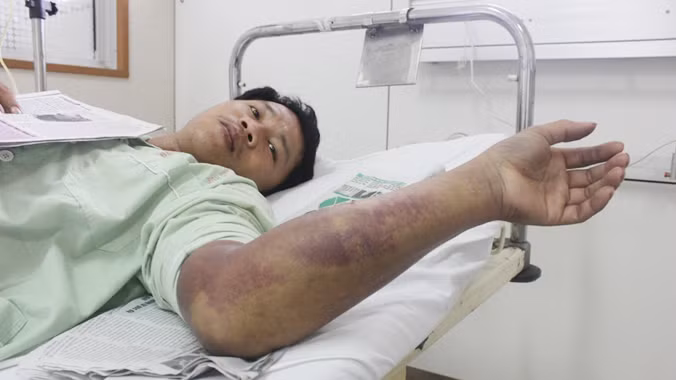 Bệnh nhân Hoàng Minh Quang đang được điều trị tại khoa Hồi sức cấp cứu, bệnh viện TW Huế.