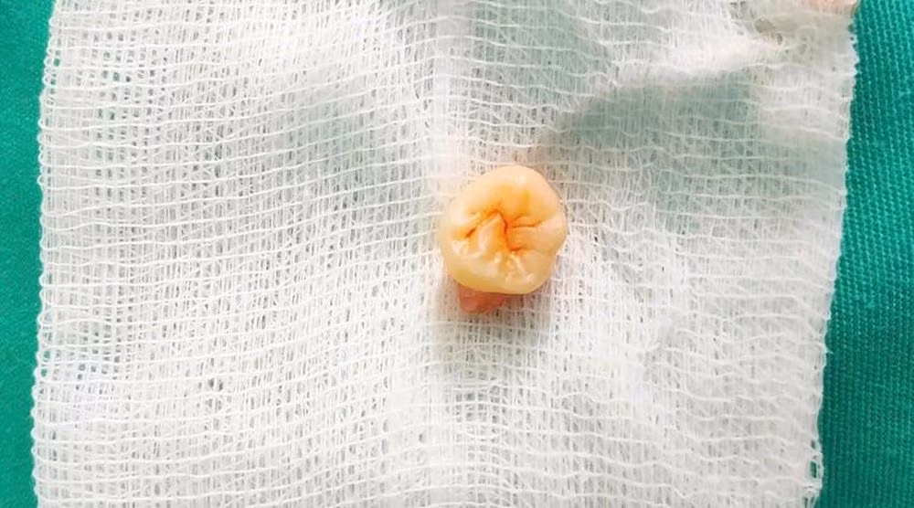 Chiếc răng khôn mọc "lạc chỗ" gây đau đớn cho bệnh nhân trong thời gian dài đã được phẫu thuật, lấy ra khỏi cơ thể.