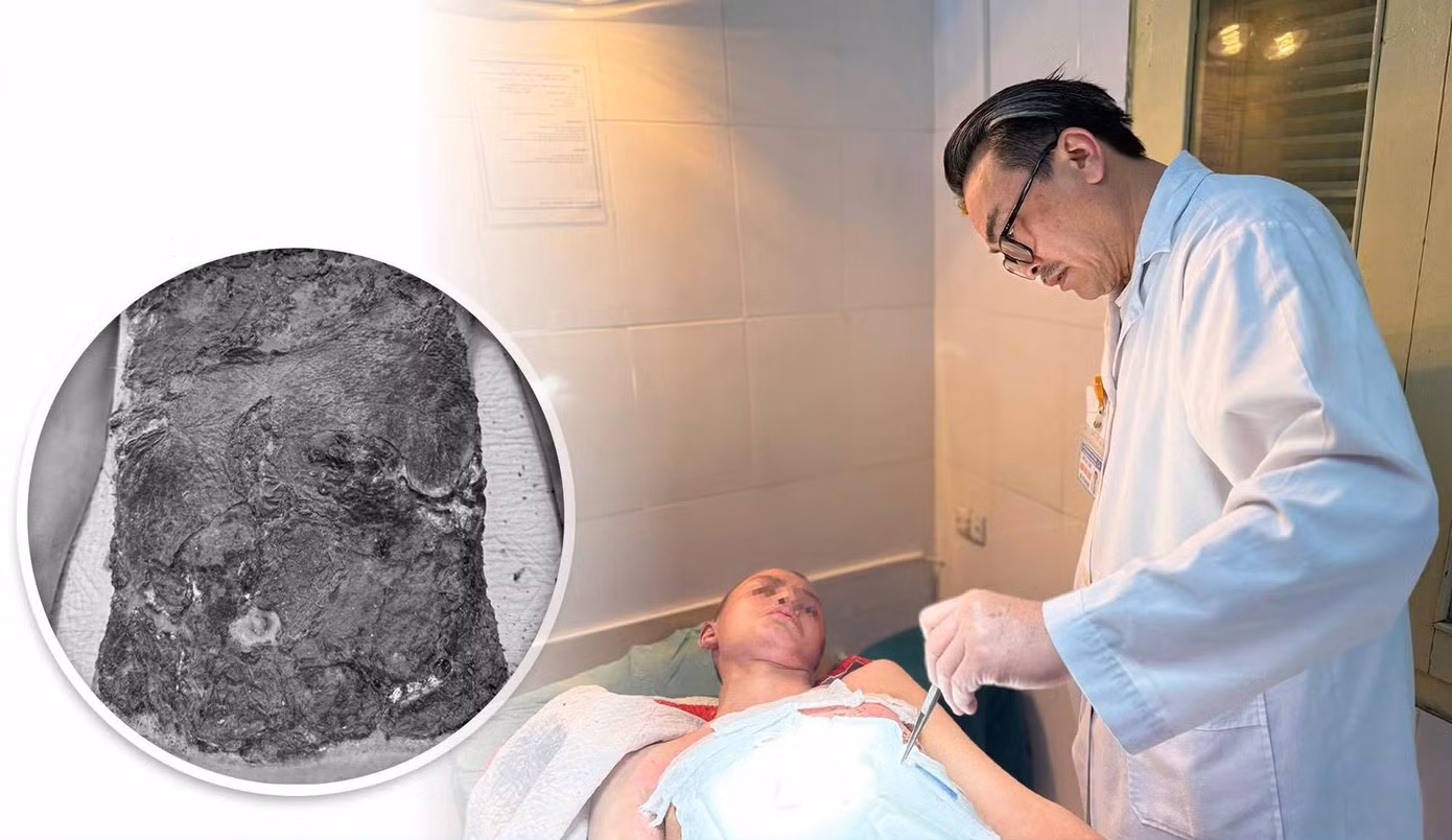 Các bác sĩ đã tiến hành cắt lọc phần da hoại tử, chờ ghép da tự thân.