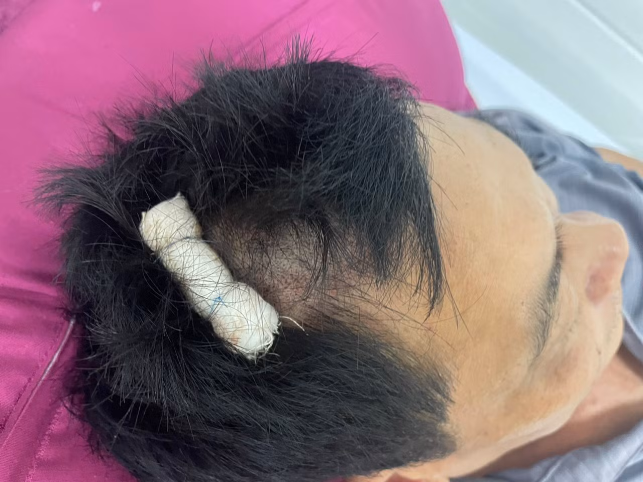 Ông H. được khâu 5 mũi vết thương trên đầu.