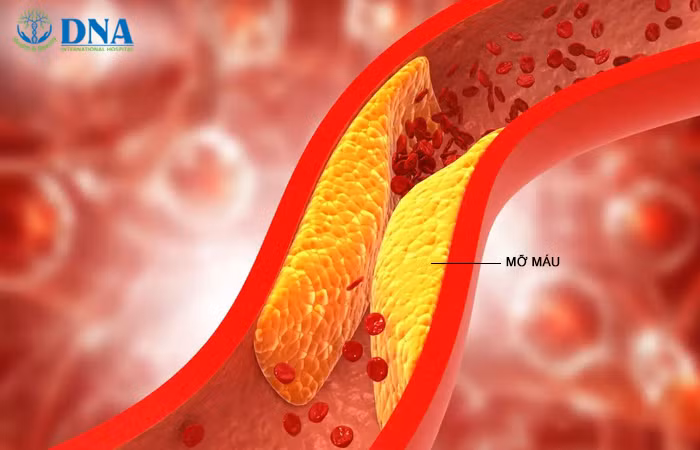 Mỡ máu xấu tăng cao lâu ngày bám vào thành mạch gây hẹp lòng mạch