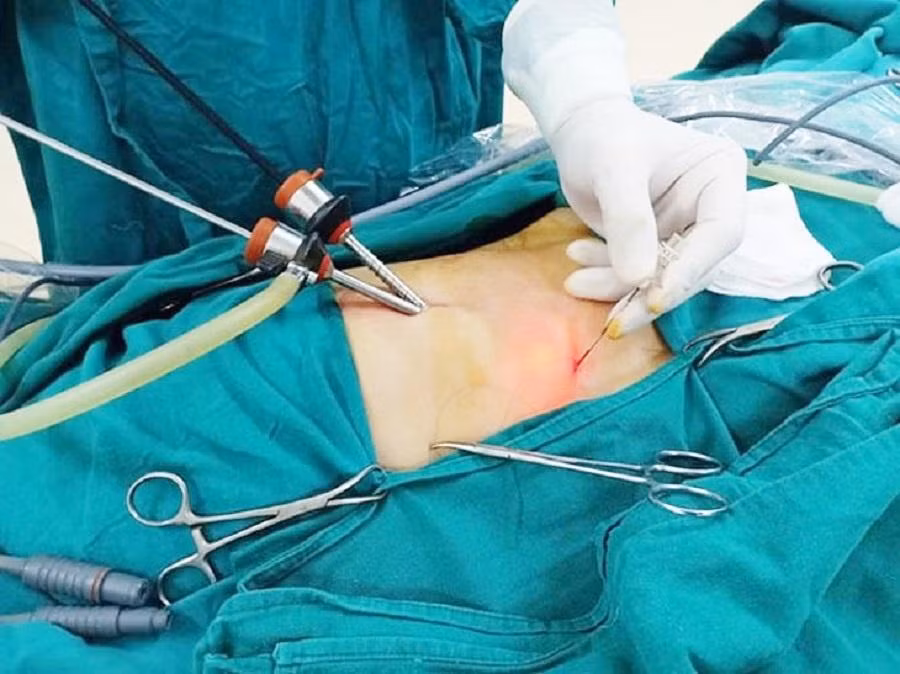 Bác sĩ thực hiện nội soi cắt túi mật cho người bệnh tại Bệnh viện Bình Dân TPHCM