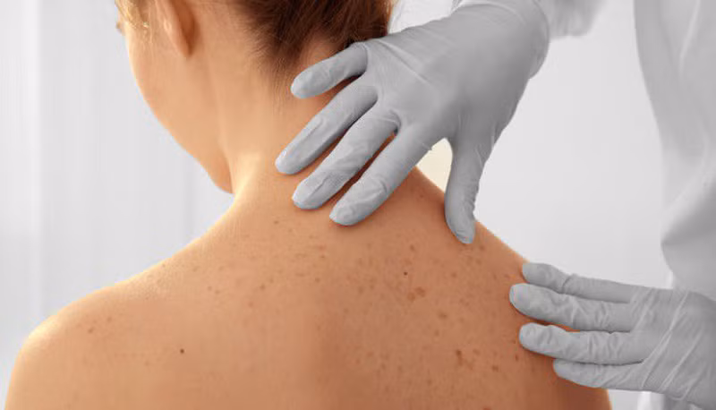 Ánh nắng mặt trời giờ nào dễ gây ung thư da nhất? ảnh 1