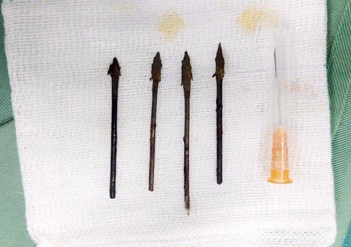4 đầu mũi tên dài 5 cm được các bác sĩ lấy ra.
