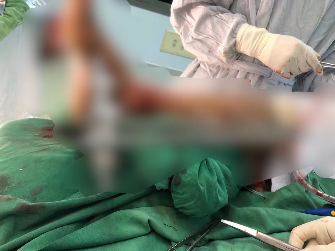Cổ chân của nạn nhân bị máy cắt cỏ chém đứt lìa