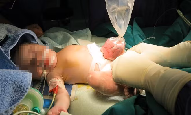Cứu sống bé gái sơ sinh có nội tạng "lộ thiên" ảnh 1