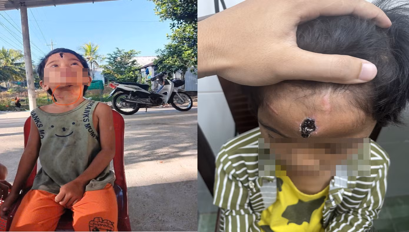 Vết thương cháu N.T.N bị cha dượng đánh đập.