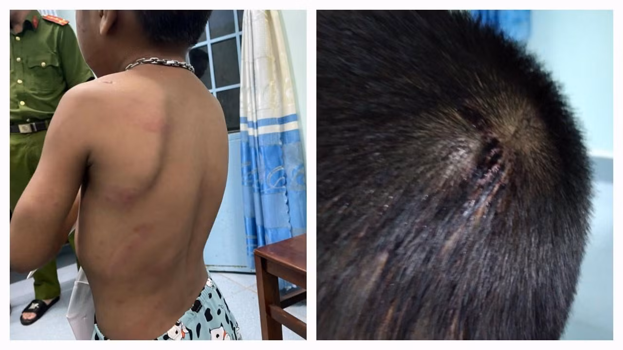 Bé T. bị Luận đánh gây thương tích.