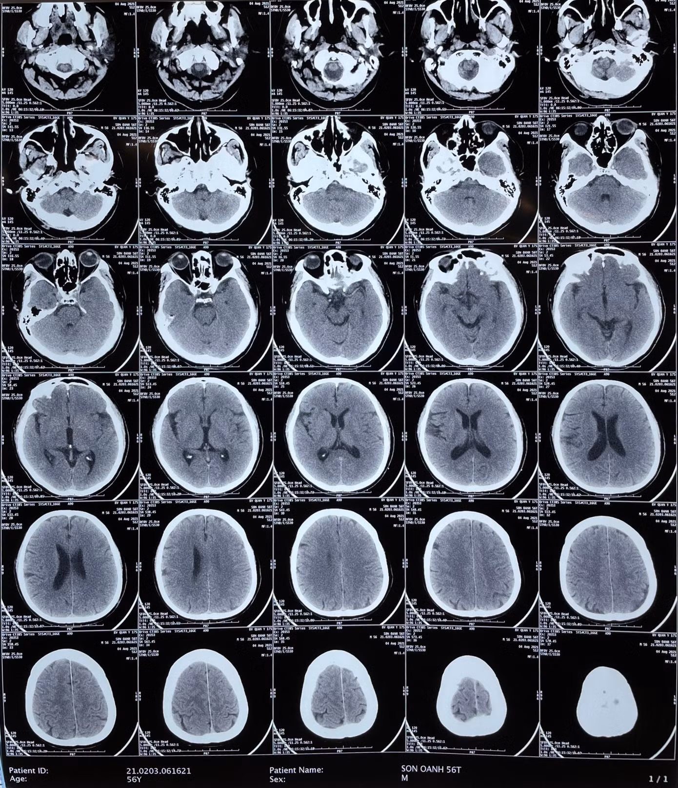 Hình ảnh chụp CT não bệnh nhân.