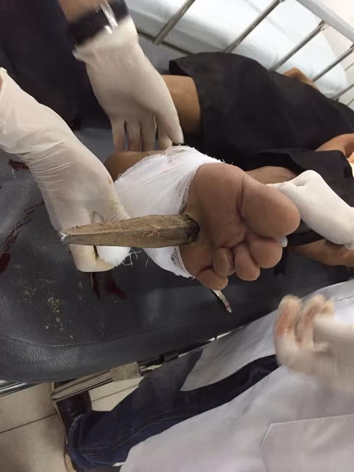 Liên tục các ca tai nạn đâm xuyên cơ thể nhập viện cấp cứu ảnh 1