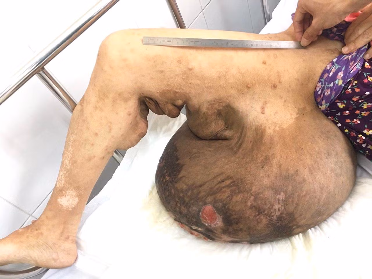 Một trường hợp bị u sợi thần kinh khổng lồ từng điều trị tại Bệnh viện Chợ Rẫy