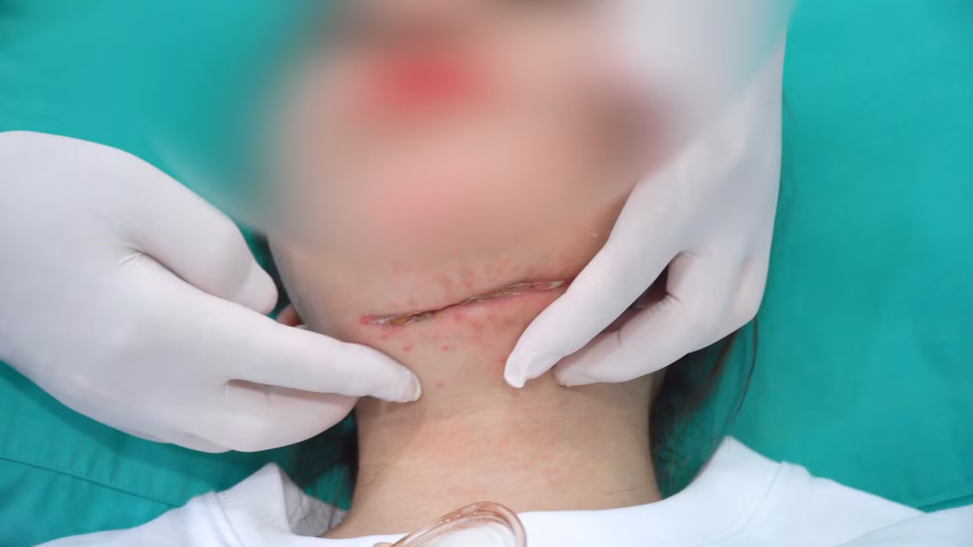 Bệnh nhân nhập viện với vết cắt trên cổ đang nhiễm trùng hoại tử, đe dọa tính mạng
