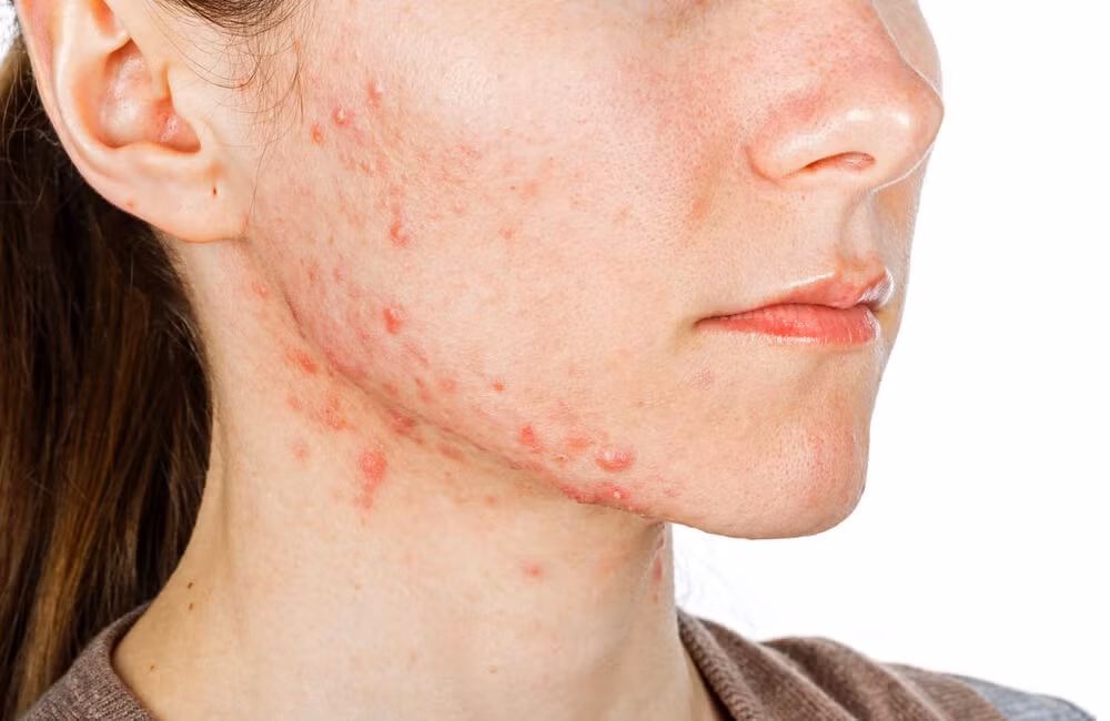 Mặc dù mụn trứng cá không gây hại nhiều đến sức khỏe nhưng lại ảnh hưởng rất lớn đến thẩm mỹ và tâm lý.