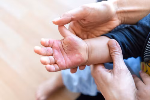 Trẻ dễ bị bỏng trong khi người lớn chuẩn bị các món ăn ngày Tết.