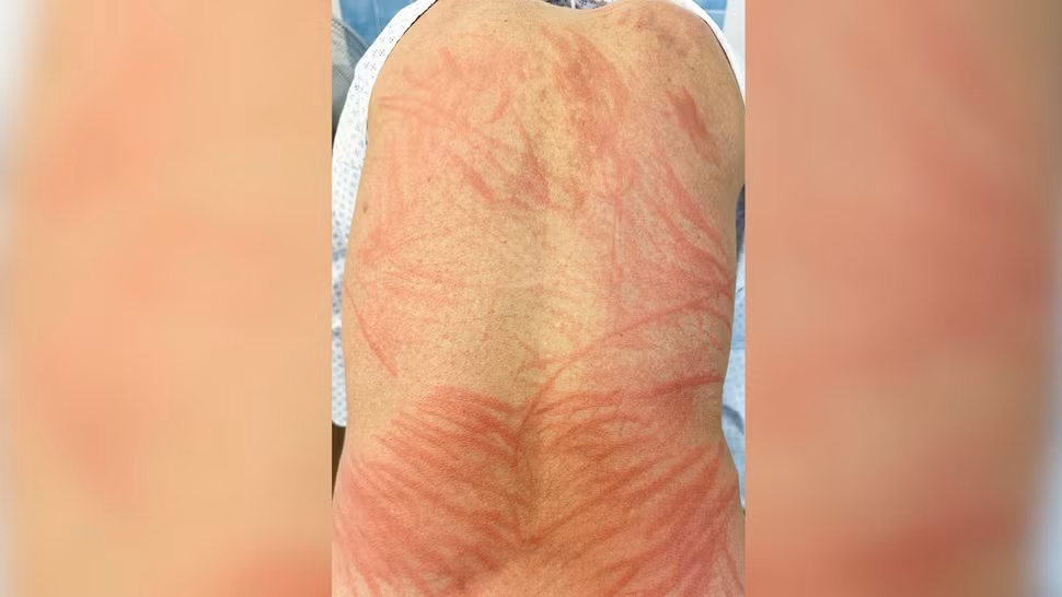 Vết mẩn ngứa, đau đớn bùng phát khắp lưng và mông người đàn ông sau khi ăn nấm hương nấu chưa chín kỹ. (Ảnh: Tạp chí Y học New England ©2023)