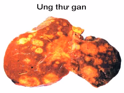  6 bộ phận trên cơ thể người dễ bị ung thư nhất