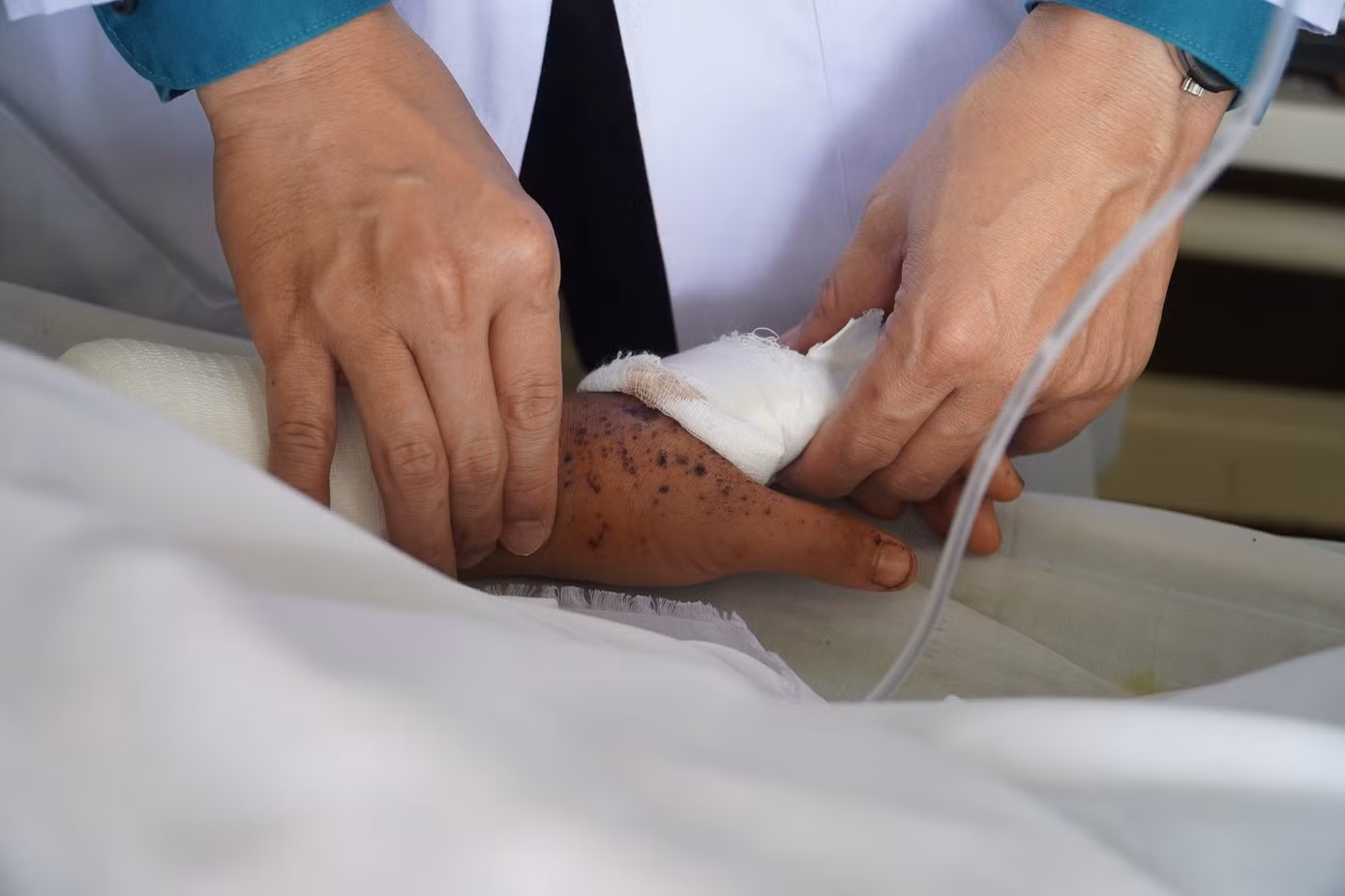Nạn nhân nhập viện với vết thương hỏa khí gây ra trên toàn thân