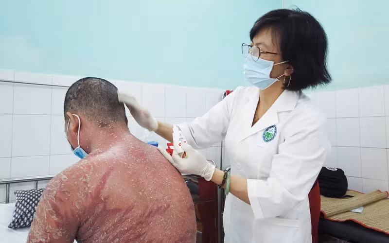 Nam thanh niên đã bị "lột da" toàn thân sau khi sử dụng thuốc trôi nổi trên mạng xã hội để trị bệnh vảy nến