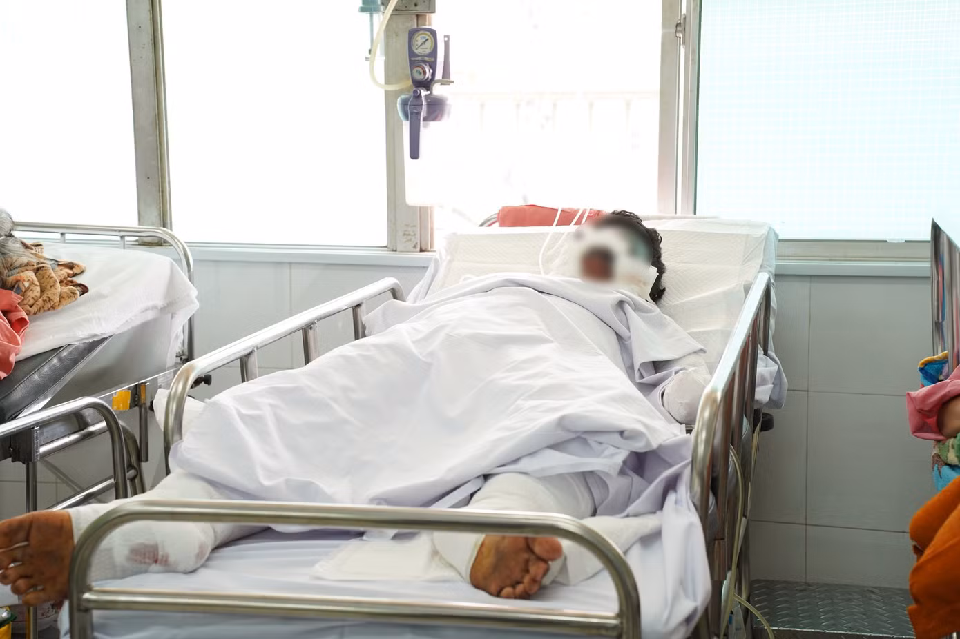 Một trường hợp nguy kịch sau tai nạn pháo tự chế, phải cắt cụt tay trái bị dập nát để tránh nguy hiểm đến tính mạng