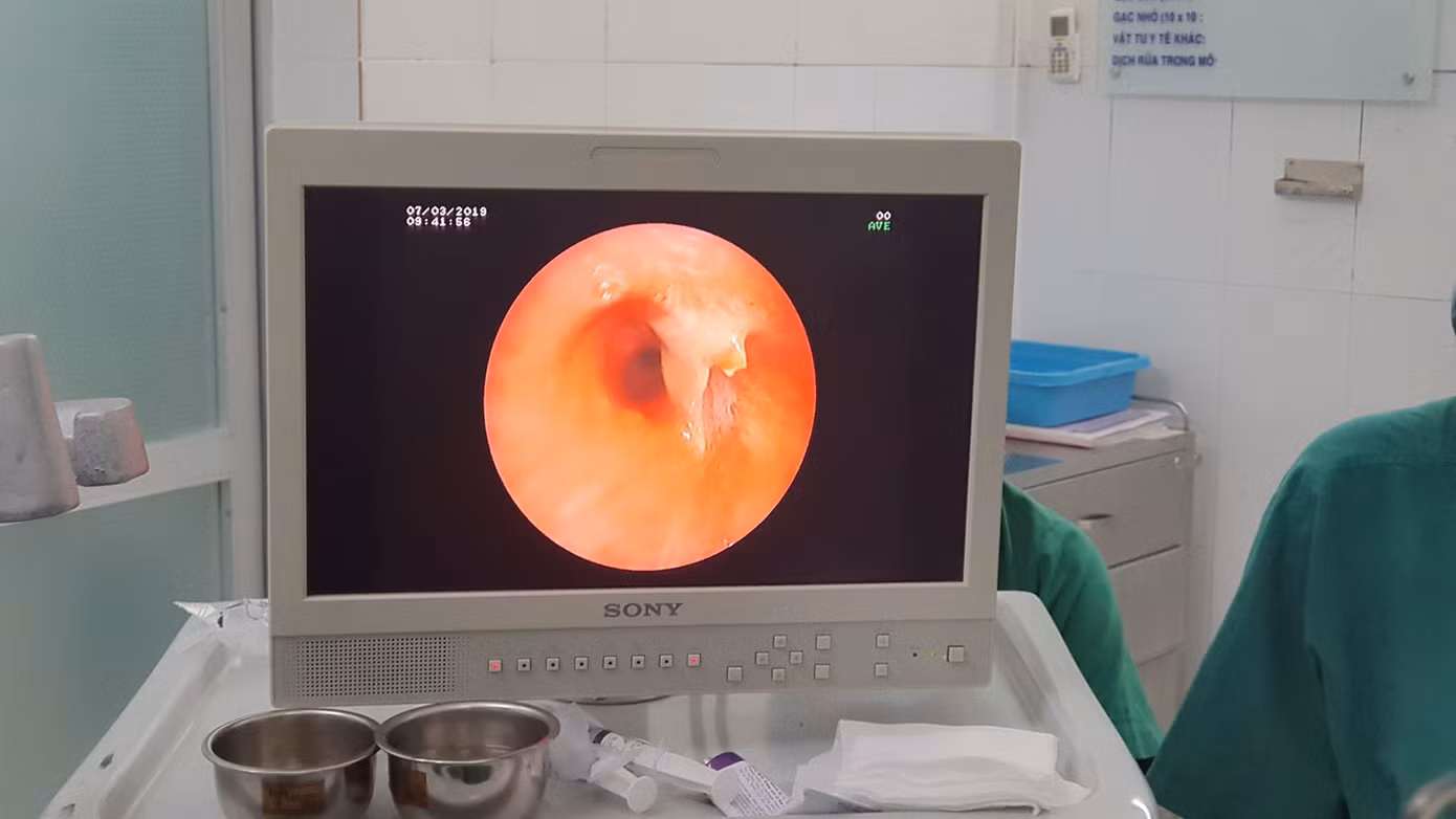 Gắp thành công xương cá kẹt trong đường thở bệnh nhân suốt 3 năm ảnh 2