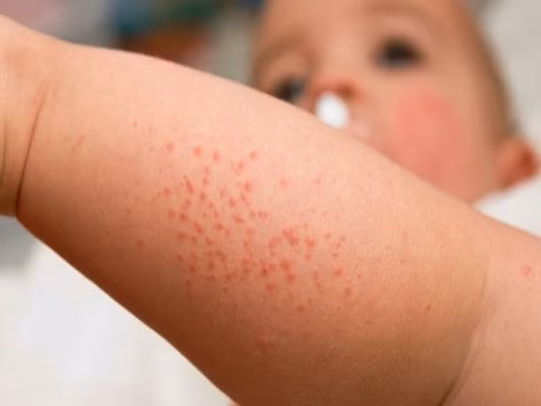 Những loại thuốc 'uống là chết' khi bị sốt xuất huyết ảnh 2