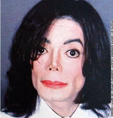 Michael Jackson cũng là thảm họa của các ca phẫu thuật