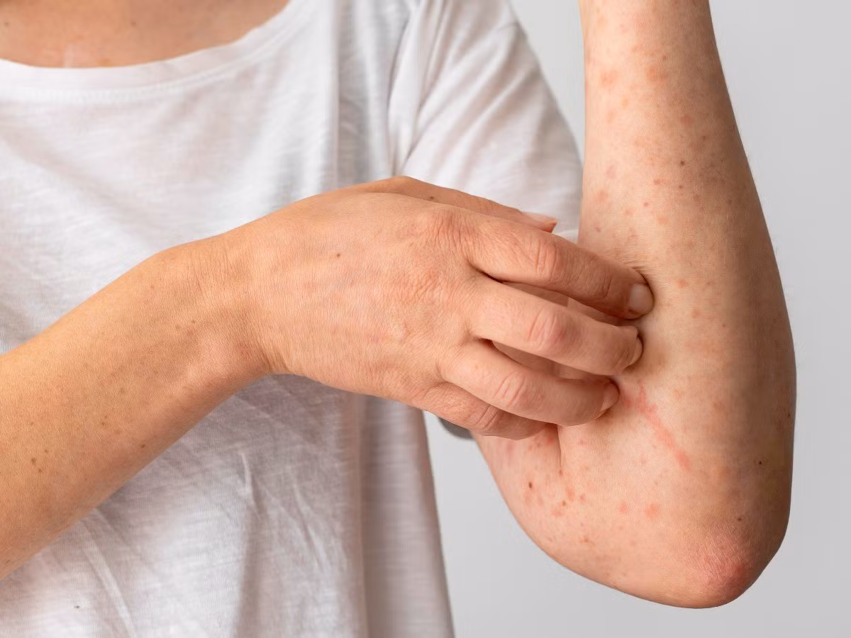 Ký sinh trùng ghẻ có thể xâm nhập vào lớp biểu bì, gây ngứa dữ dội và nổi mụn nước.