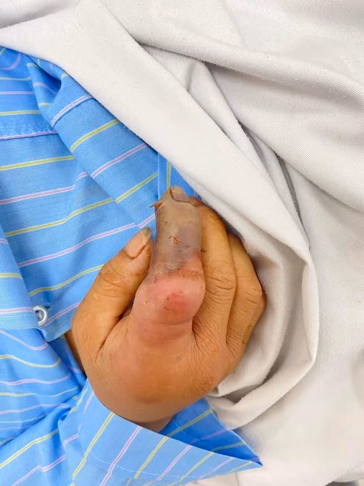 Bệnh nhân bị rắn hổ mang bành cắn đang điều trị tại BV Đa khoa tỉnh Hòa Bình. Ảnh; BS cung cấp