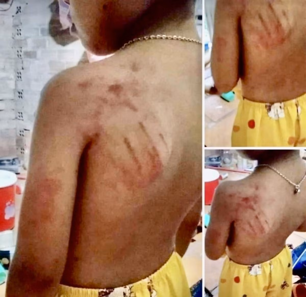 Vết bầm trên lưng học sinh sau khi bị cô T. đánh.