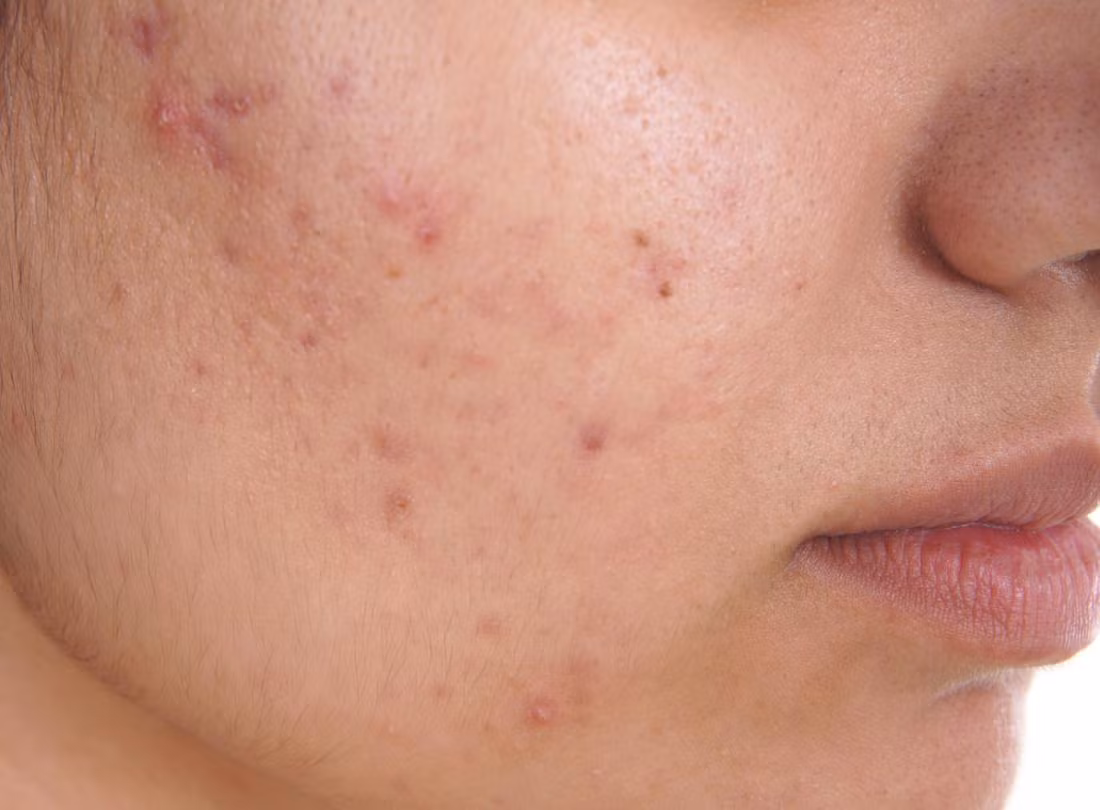 Mụn trứng cá ảnh hưởng đến thẩm mỹ và gây mất tự tin cho 'khổ chủ'.