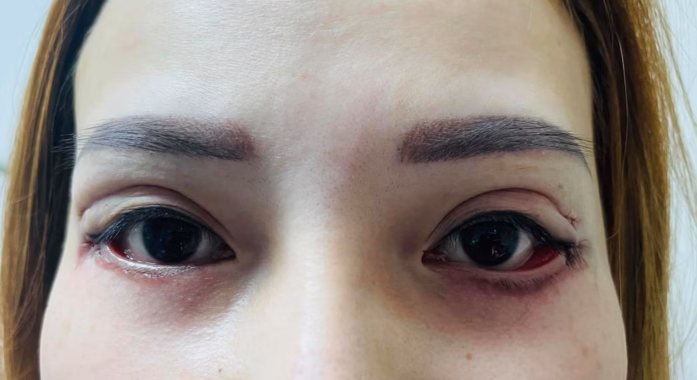 Sau phẫu thuật, đôi mắt của bệnh nhân đã gần trở lại được trạng thái ban đầu