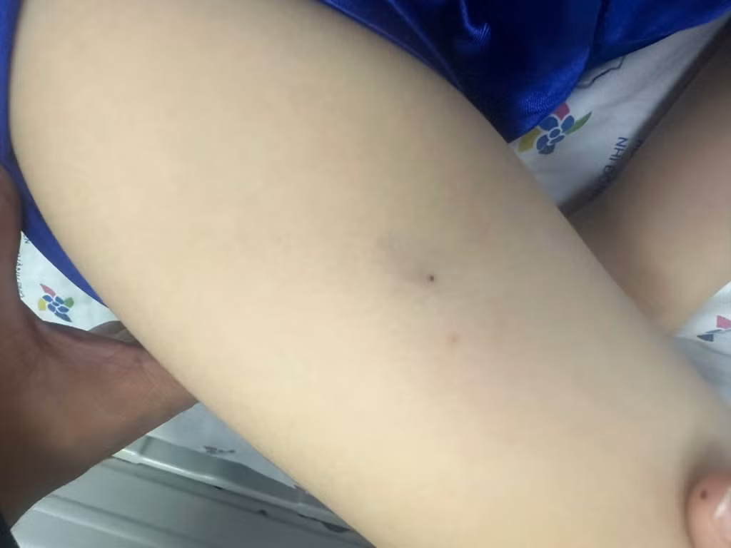 Vết đốt ong ruồi trên cơ thể của trẻ được bác sĩ xác định là nguyên nhân dẫn tới sốc phản vệ
