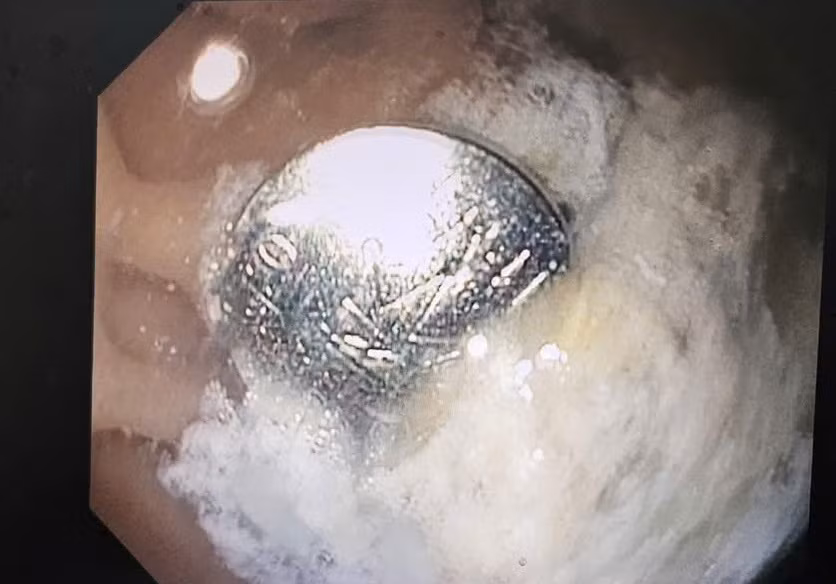 Cục pin được phát hiện nằm trong dạ dày của bệnh nhi trên hình ảnh nội soi