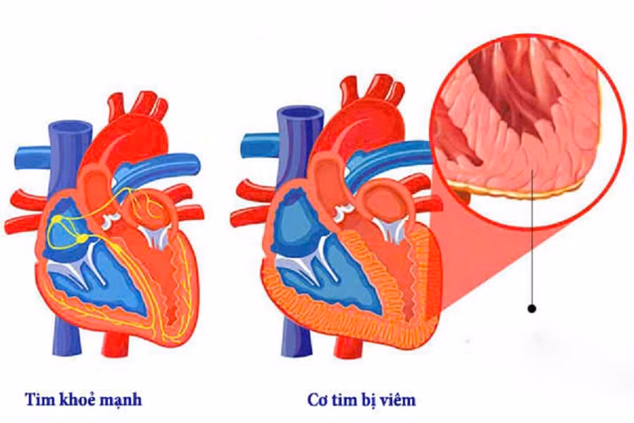 Hình ảnh minh họa cơ tim khỏe mạnh bình thường và cơ tim bị viêm
