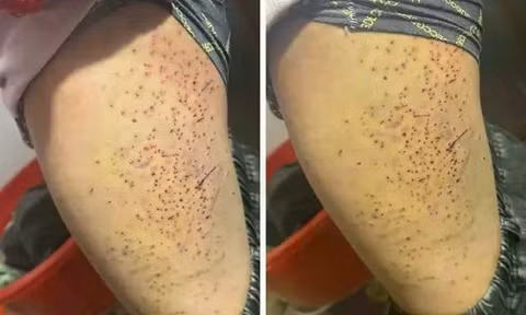 Nguyên nhân vụ học sinh lớp 7 ở Lào Cai bị bạn cùng lớp dùng bút đâm vào đùi