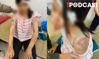 NÓNG 20/11: Bé gái bị gia đình nội tra tấn: Đây là hành vi nghiêm trọng