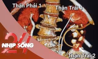 NHỊP SỐNG 24: Bất ngờ phát hiện người phụ nữ ở TP.HCM có 4 quả thận