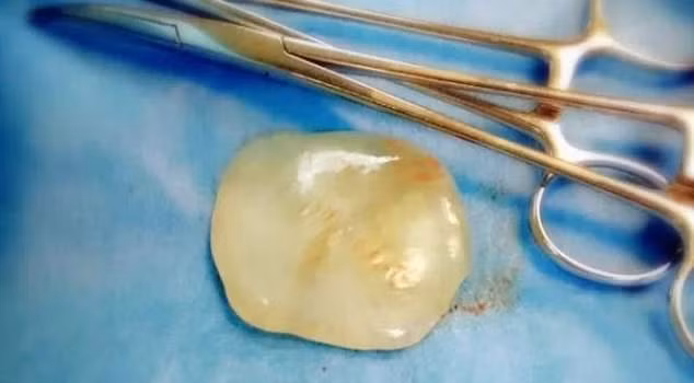 "Viên ngọc" rơi ra từ bụng sản phụ trong quá trình mổ đẻ ở Trung Quốc.